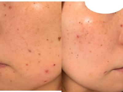 30代2児ママのシミ治療・ほくろ除去体験記 1週間後の様子