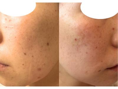 30代2児ママのシミ治療・ほくろ除去体験記 2週間後の様子