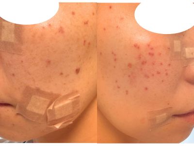 30代2児ママのシミ治療・ほくろ除去体験記 当日の様子