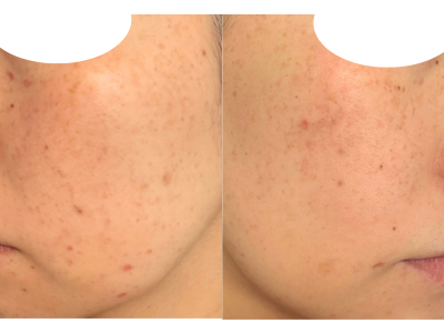 30代2児ママのシミ治療・ほくろ除去体験記　3週間後の様子